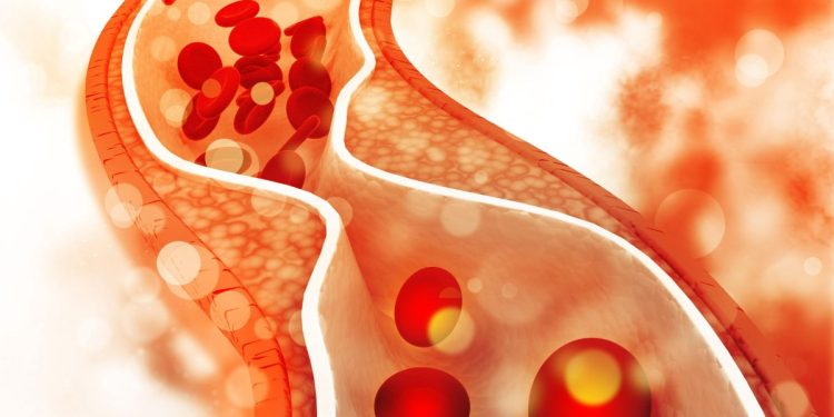 COVID-19 Can Cause New Cholesterol Problems