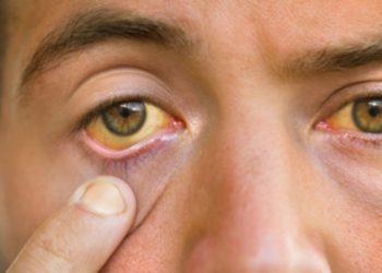 yellow eyes symptoms of these disease